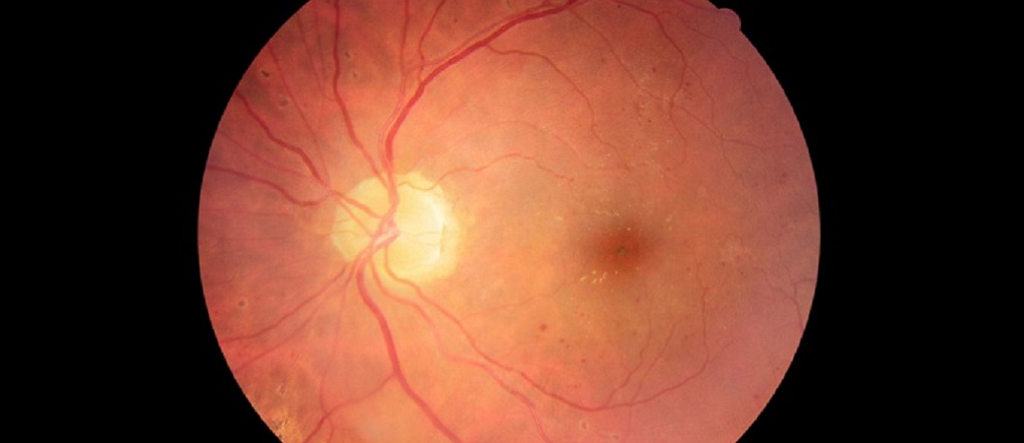 Analýza snímku očního pozadí odhalí nejen onemocnění zraku, ale i řadu dalších chorob. S diagnostikou pomůže umělá inteligence